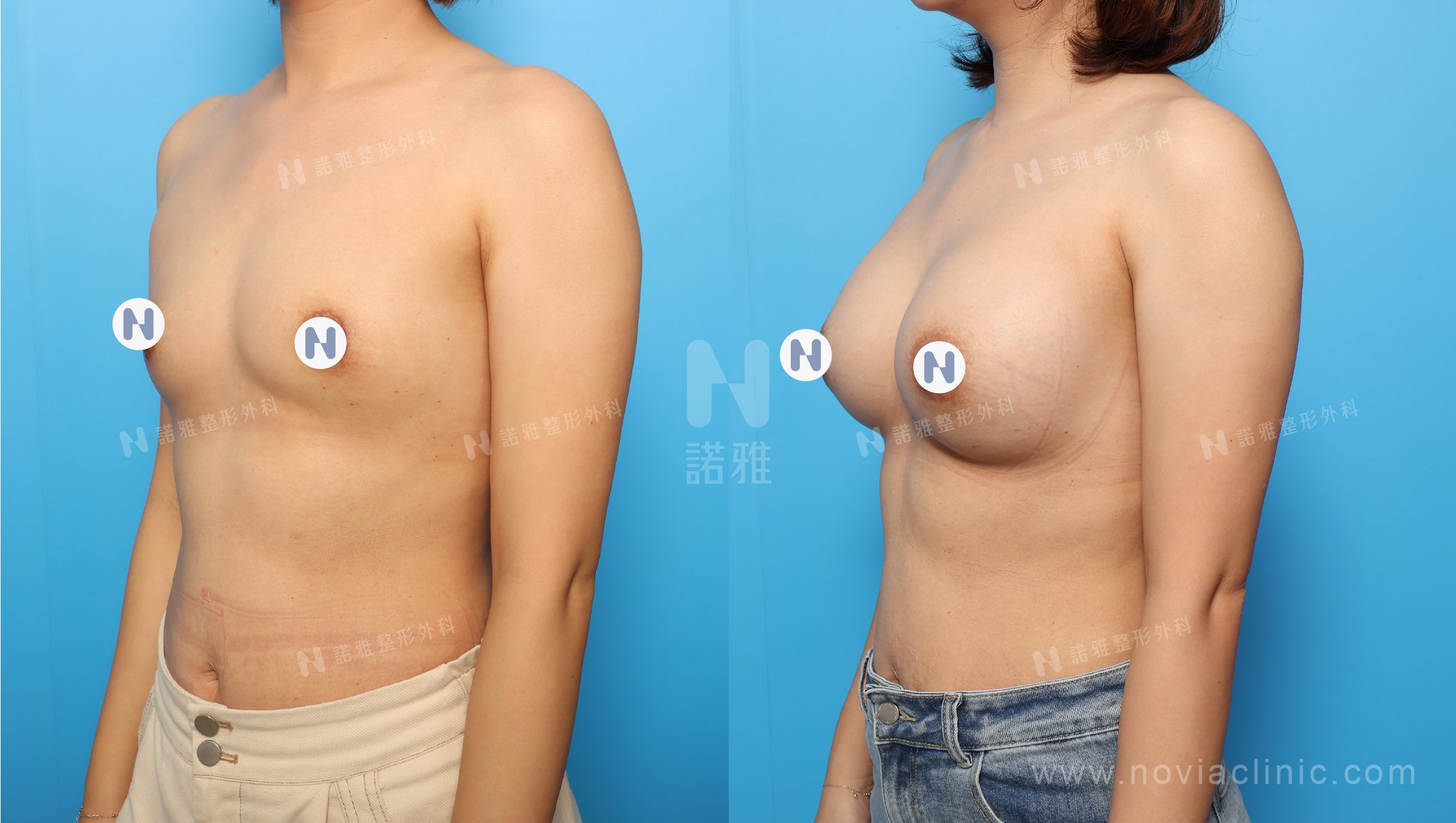 珍珠波隆乳手術