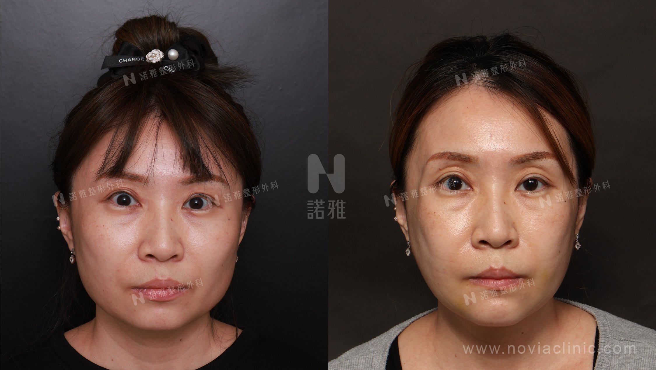 削骨手術案例